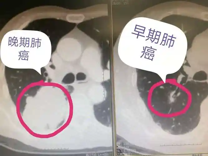 左图为晚期肺癌,右图为早期肺癌(5年前)但是天不遂人愿,半年后,一次