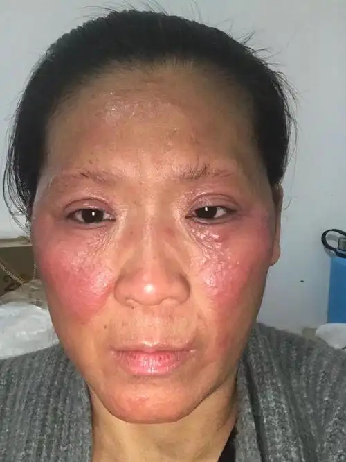 26年湿疹,重度激素依赖性皮炎,重度黑变病修复痊愈,修复2年10个月