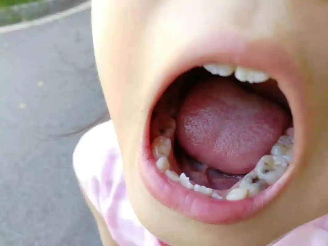 儿童牙齿虫牙龋齿怎么办?终止儿童牙齿虫牙龋齿有方法