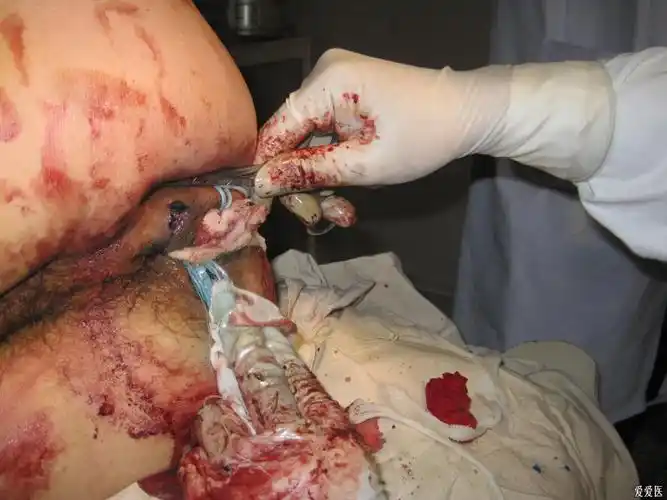 一例后马蹄形肛瘘