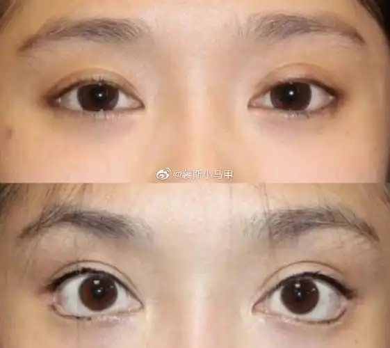 眼睑下至后遗症不算少