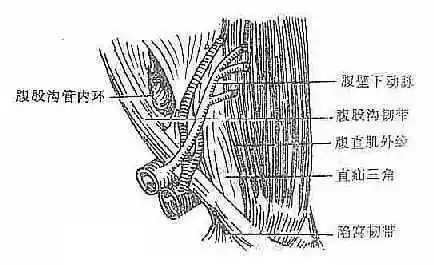 直疝(hesselbach)三角