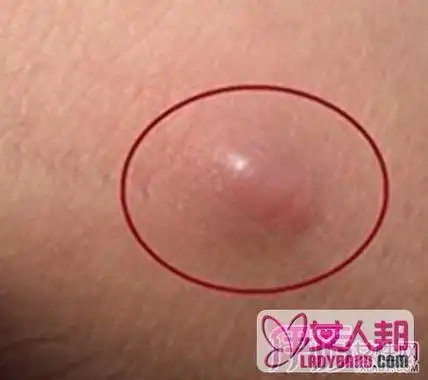 大腿根部有肿块,考虑是腹股沟淋巴结肿大,可发生于任何年龄段人群,可