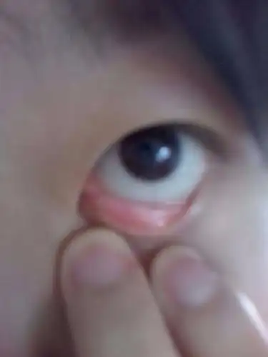 问:最近几天内眼角突然觉得痒,今天早上眼角红肿了.