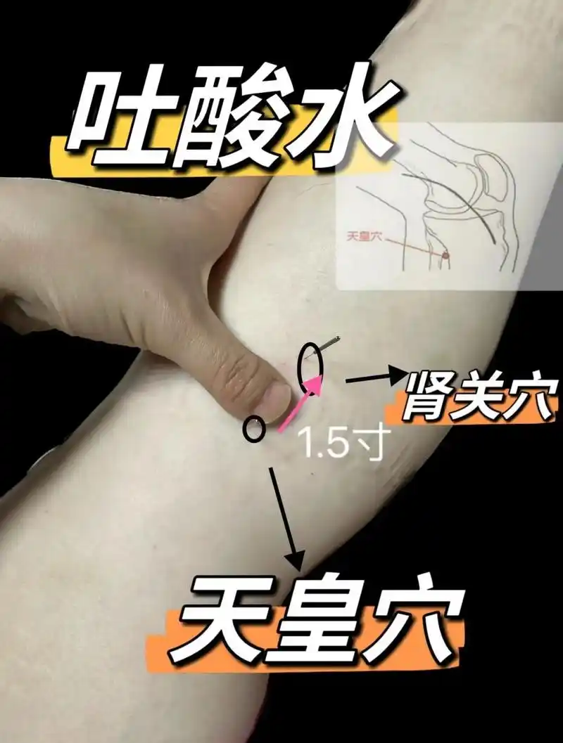 吐酸水(天皇穴 肾关穴) 功效与作用: 天皇穴可入心经和肾经,能清热化