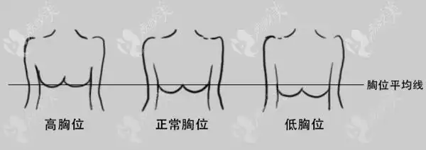 隆胸水滴形和圆形哪个好哪个形态自然看图片真人效果对比便知