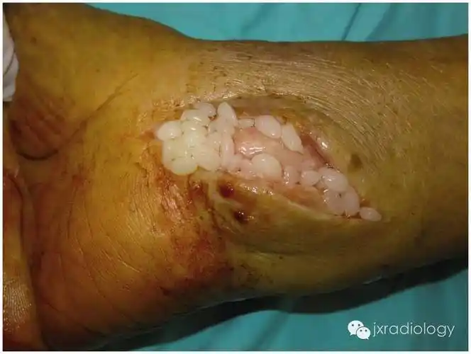 米粒体是多发小的类似于抛光的大米的游离体,存在于滑液或滑囊