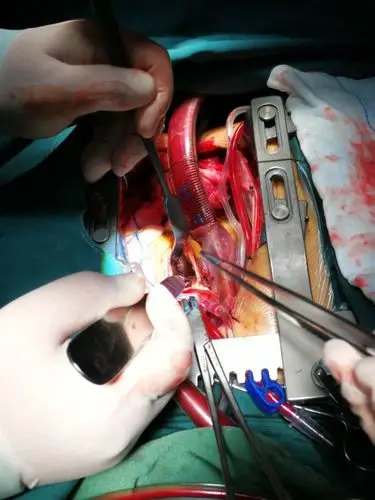 morrow~左室流出道狭窄解除术～针对肥厚性梗阻性心肌病的外科治疗