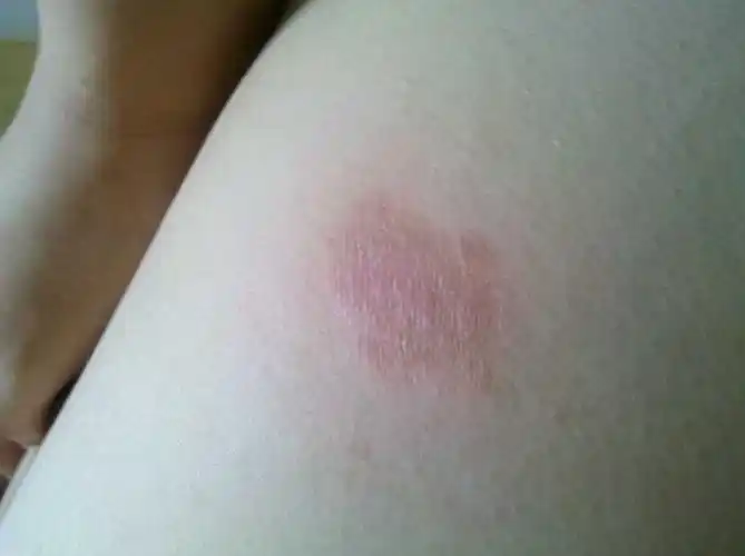 最近半个月身上起红斑,最初只是一个红斑