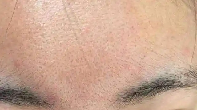 >> 缺水型毛孔粗大   --------- 解决方案: 因为缺水造成的