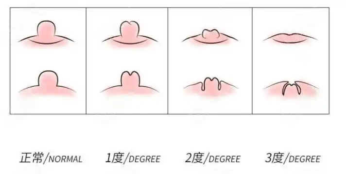 21岁乳头内陷三级怎么矫正过来?这种重度内陷能戴矫正器吗