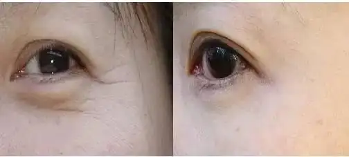 暨大美塑量子菁:女人衰老从脸开始,这4个习惯加深脸部细纹