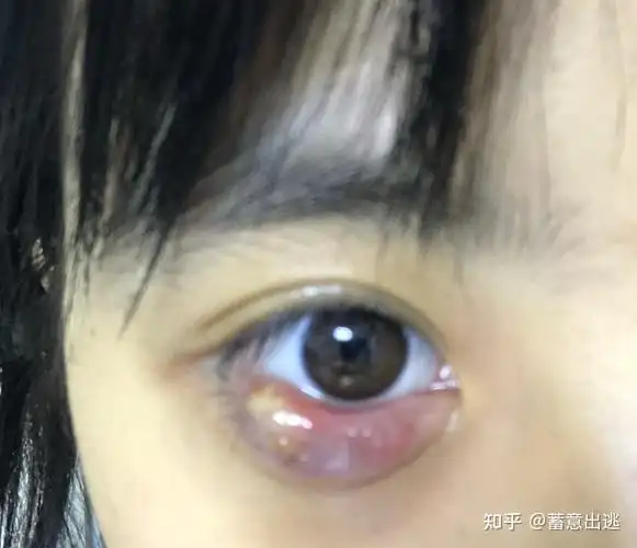 记录麦粒肿撅眼