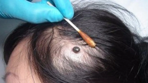 孩子头上长了个包,发烧就没停过而且总头疼,扒开头发吓了一跳