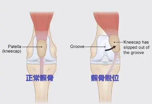 髌骨别跑,一篇文章全面了解髌骨脱位