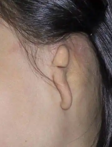 一度小耳畸形二度小耳畸形三度小耳畸形