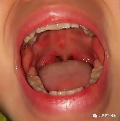 手足口病皮疹越多越严重吗