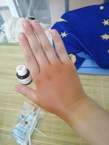 被马蜂蛰了之后只把针挤出来了没处理但是第二天早上起来手背肿了