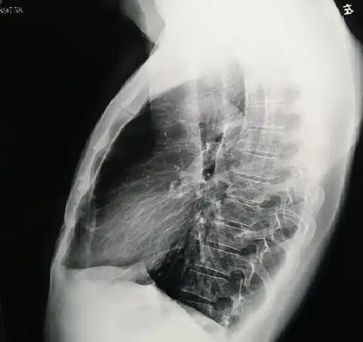 图2,正位x线片未见明显异常,肺野没有肺气肿征象.图1,胸壁外观呈桶状.