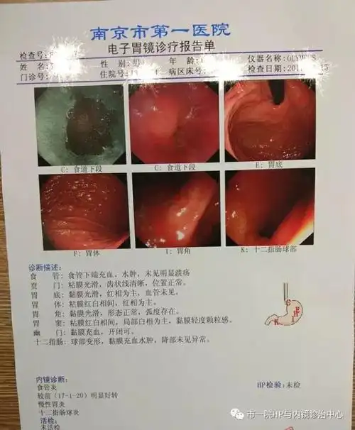 胃炎胃癌离我们越来越近这四种人应做胃镜检查专家教你如何看懂胃镜