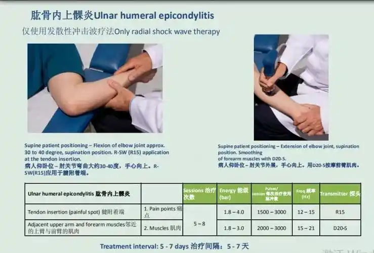 冲击波治疗学习之三——肱骨内上髁炎_网球肘_发病原因_症状表现_治疗
