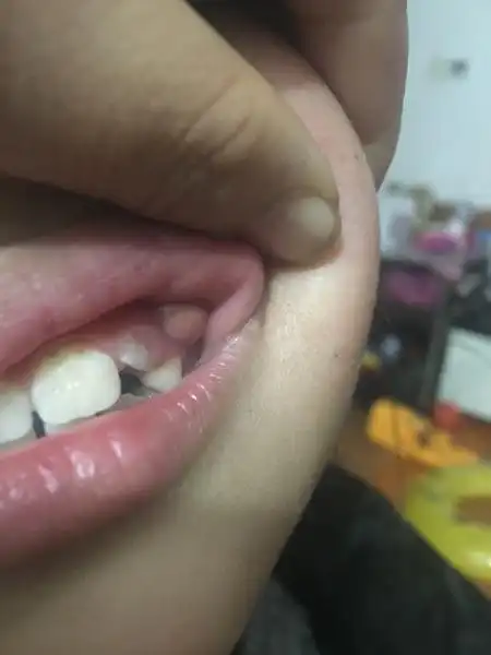 牙龈上长了一个囊肿