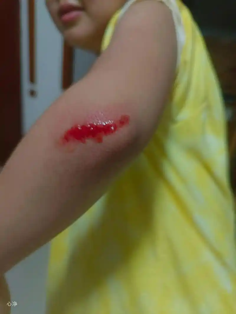 热门 95小宝手臂摔破了, 茶树精油擦77栀子压片含, 按照 - 抖音