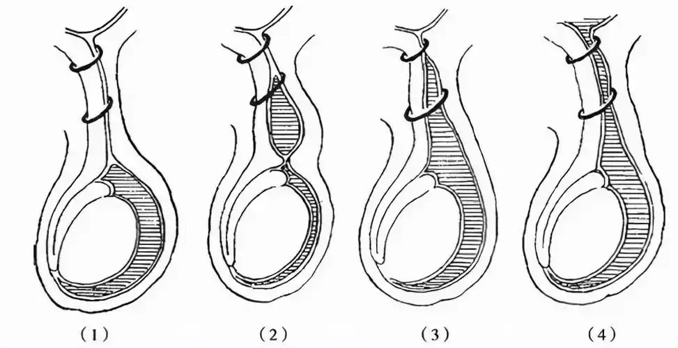 (4)交通性鞘膜积液(3)睾丸精索鞘膜积液(2)精索鞘膜积液(1)睾丸鞘膜