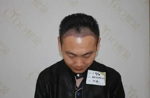 m型发际线两个角怎么补,天津熙朵李会民植发要怎么植?