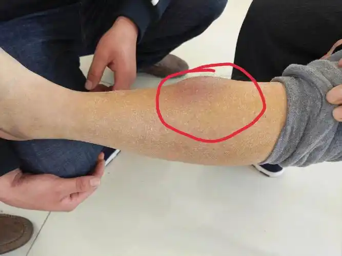 每日小课堂滑囊炎