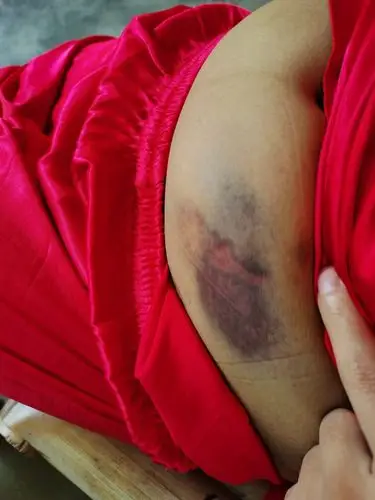 孕11周,还有7天就可以nt了,屁股黄体酮针也可以停了