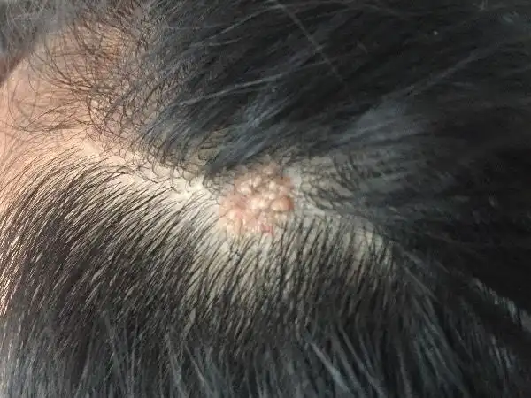 孩子头皮起了什么?不痛不痒,丘疹状