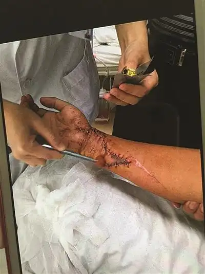 小伙被广告牌割断手臂尺动脉 伤口吓人血涌不止