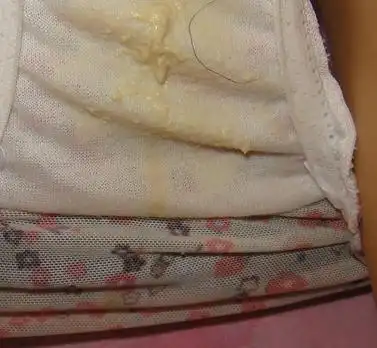 女性分泌物粘稠状特别多发黄是怎么回事