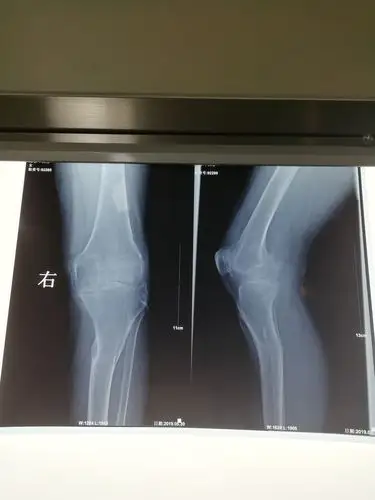 壶关县中医院成功开展人工膝关节表面置换术