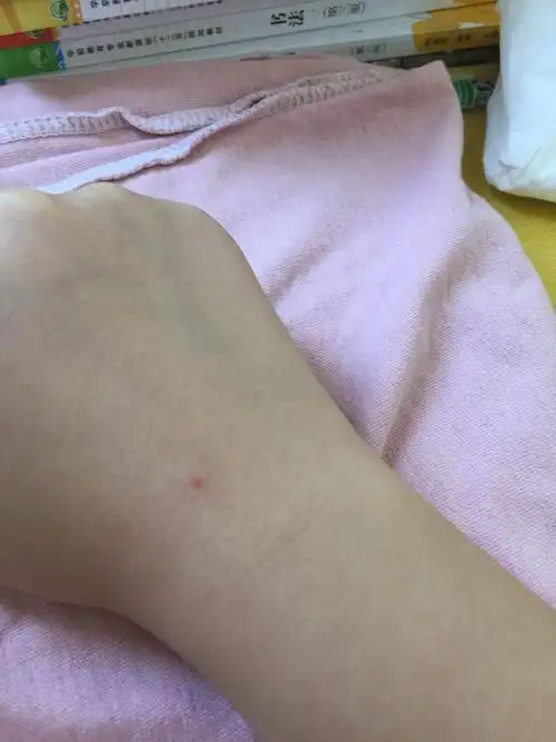 手背上突然长了一个小红点,不痛不痒