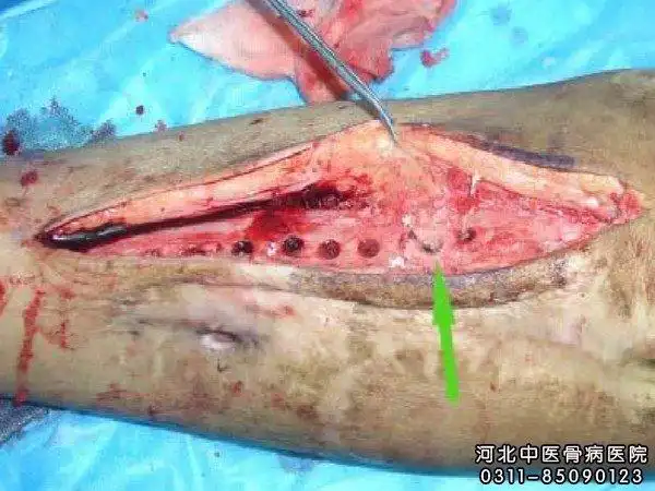 急性血源性骨髓炎的临床表现