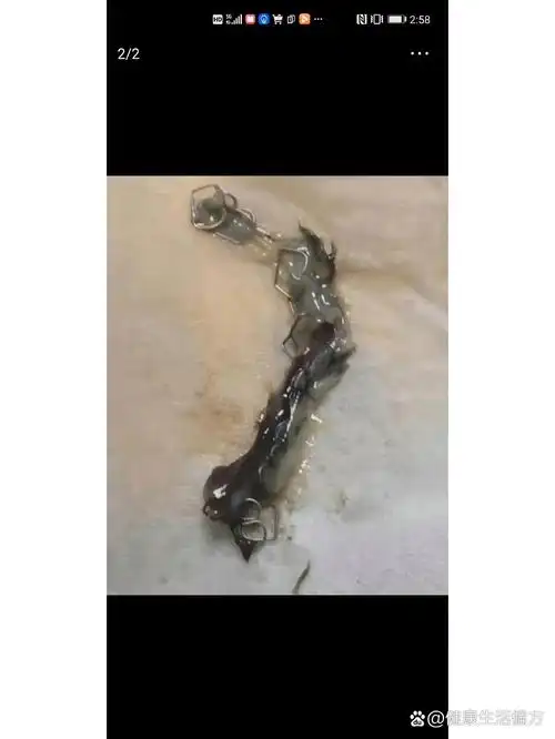 肺结节手术后咳嗽咳出钛钉怎么办?