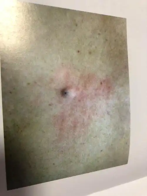 【承德县医院-彩超室-李凤艳】皮脂腺囊肿与表皮样囊肿的鉴别