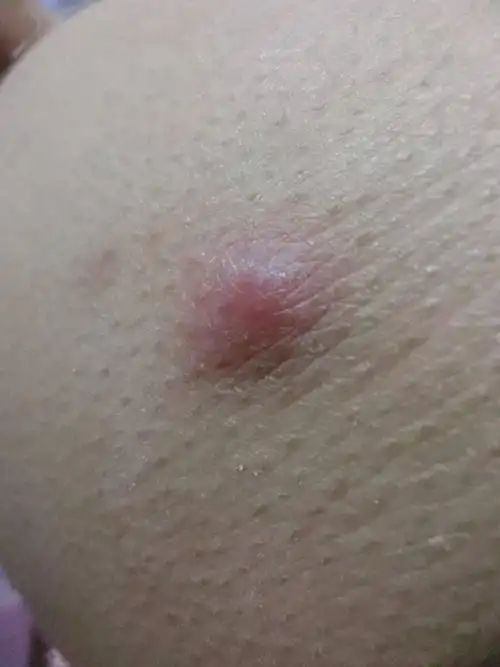 臀部长这么大个包 是怎么回事 不碰它不疼