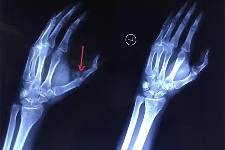 x光检查发现左手拇指骨折.(箭头所示)
