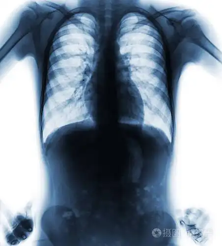 正常电影胸部x线(akimbo位置)(前视图)