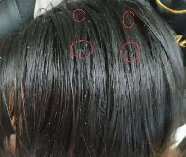 附在头发上的"白卵"是什么? 可能是3种情况, 不除掉会很严重