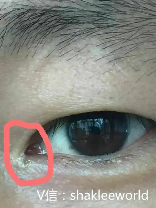 内眼角有白色分泌物是怎么回事