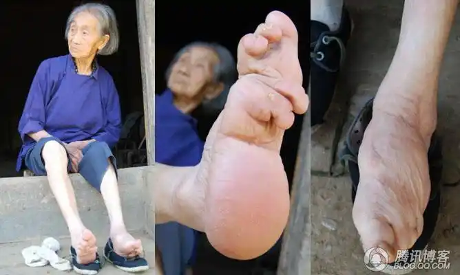 图二:老人的左脚  图三:老人的右脚特写镜头        8月24日,在丹江