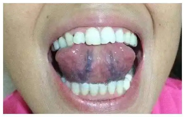 二,舌下络脉临床意义