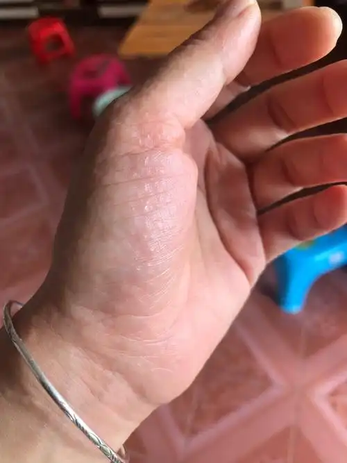 怀孕手上脚上长这么多水泡你们有吗?