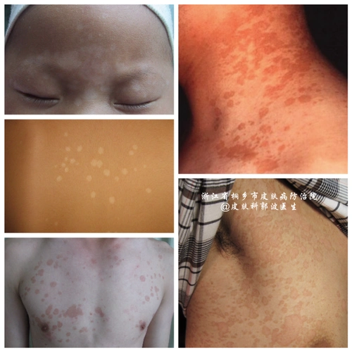 汗斑怎么治疗 胳膊上有汗斑怎么治疗