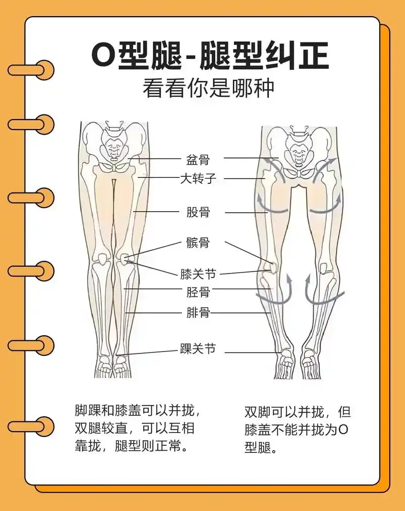 o型腿 #腿型矫正  - 抖音