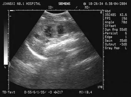 医学影像技术(医学高级):超声考试答案(最新版)